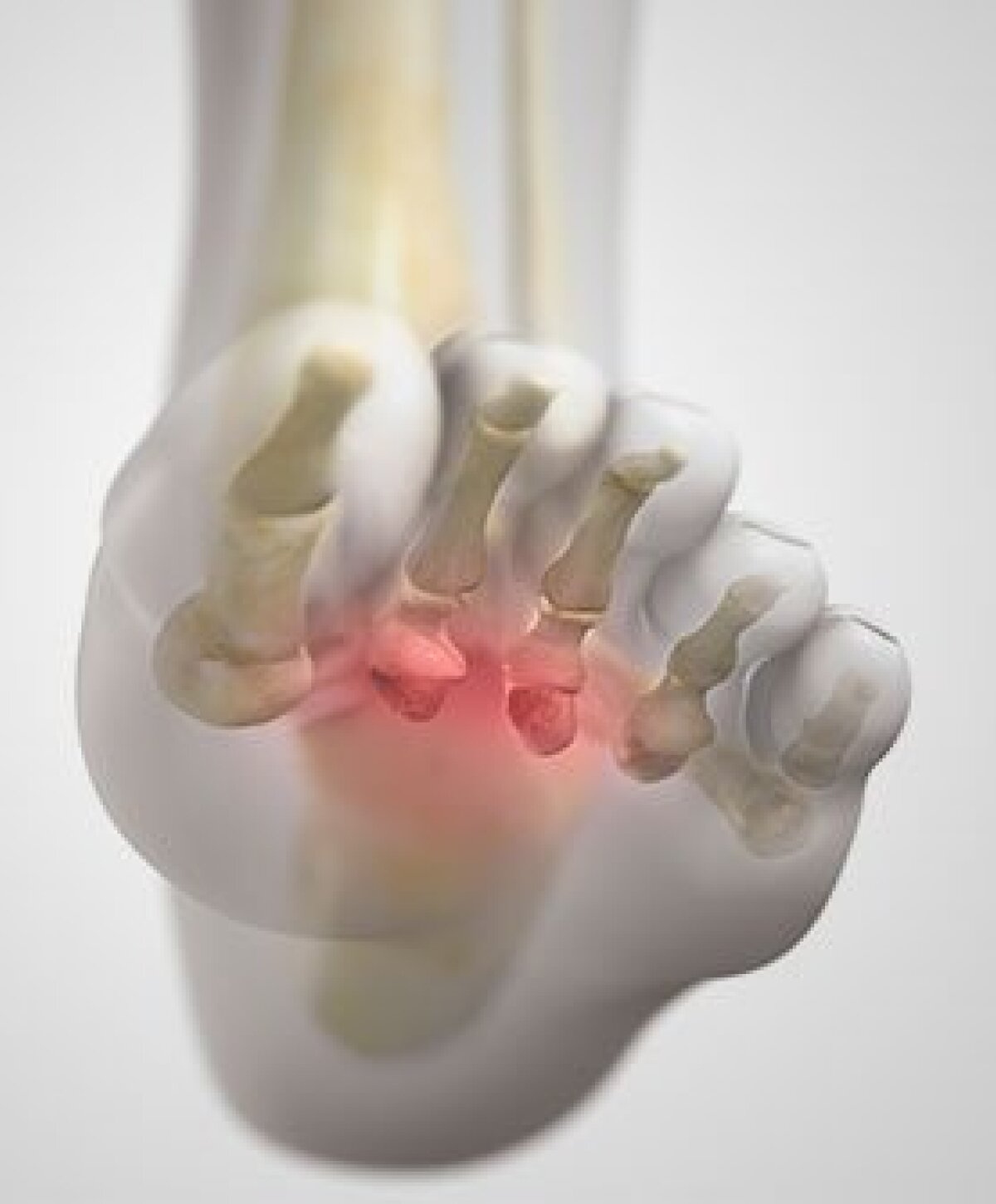 Morton’s Neuroma Treatment Morton